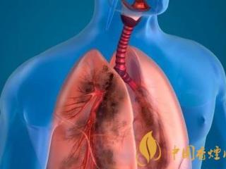 什么是间质性肺炎 患有间歇性肺炎一定要远离香烟！
